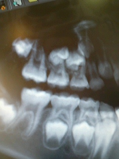 娘の歯のレントゲン写真